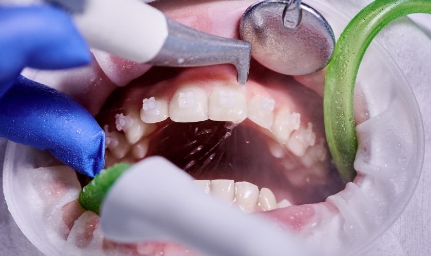 Impact Orthodontics: Transforming Smiles with Excellence and Innovation